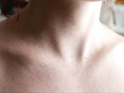 35 Every Other Freckle